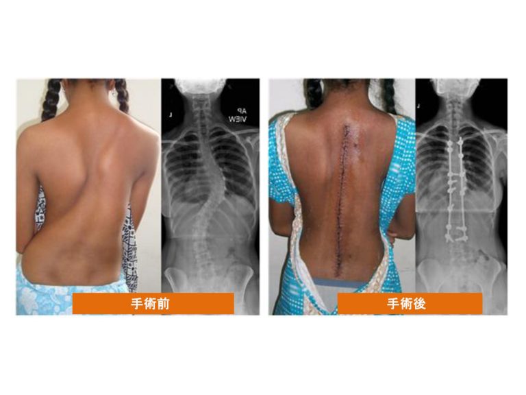 側弯症に対するその他の非外科的治療